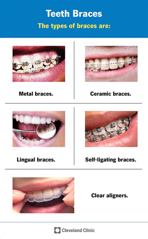 types of orthodontic brackets